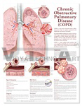 Chronic Obstructive Pulmonary Disease (COPD) Anatomical Chart, 2nd Edition